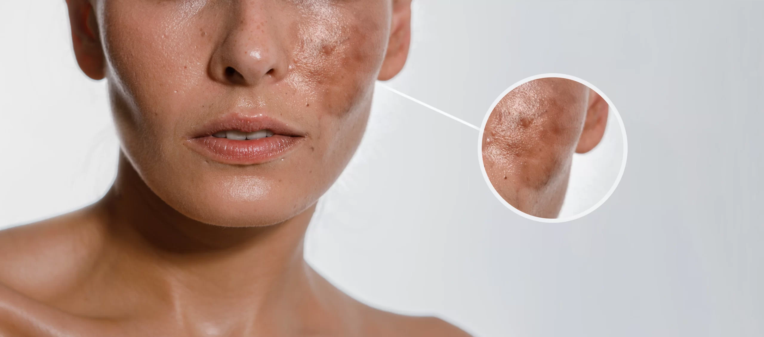 Melasma: quando as manchas na pele vão além da estética