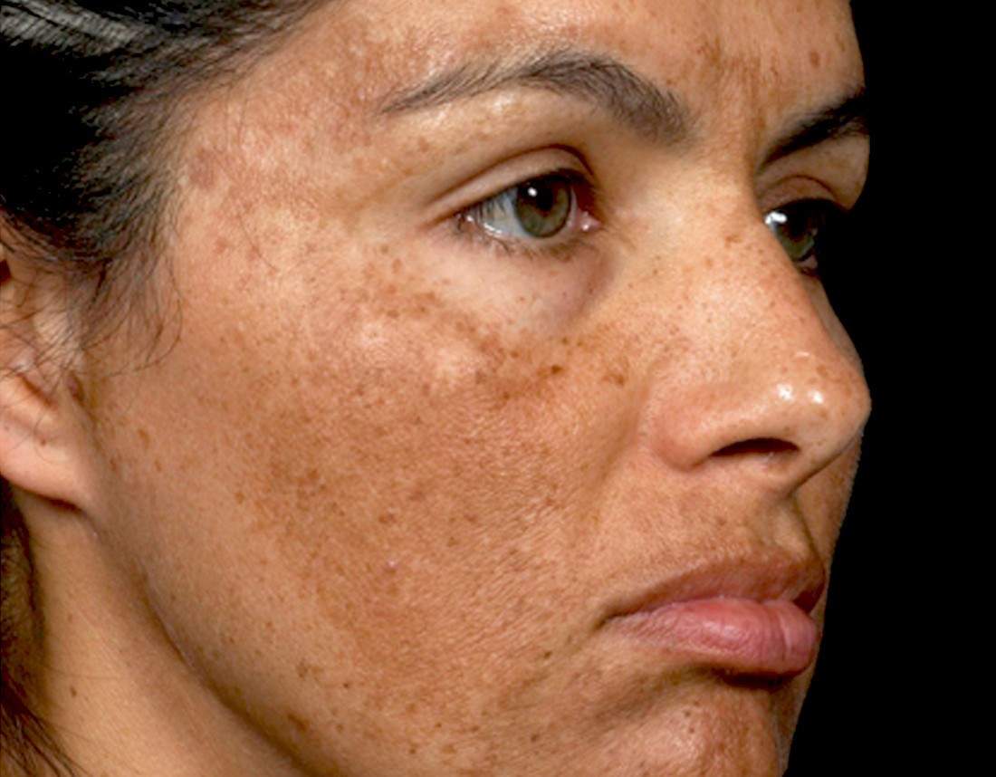 Melasma refratário: por que algumas manchas não clareiam mesmo com tratamento