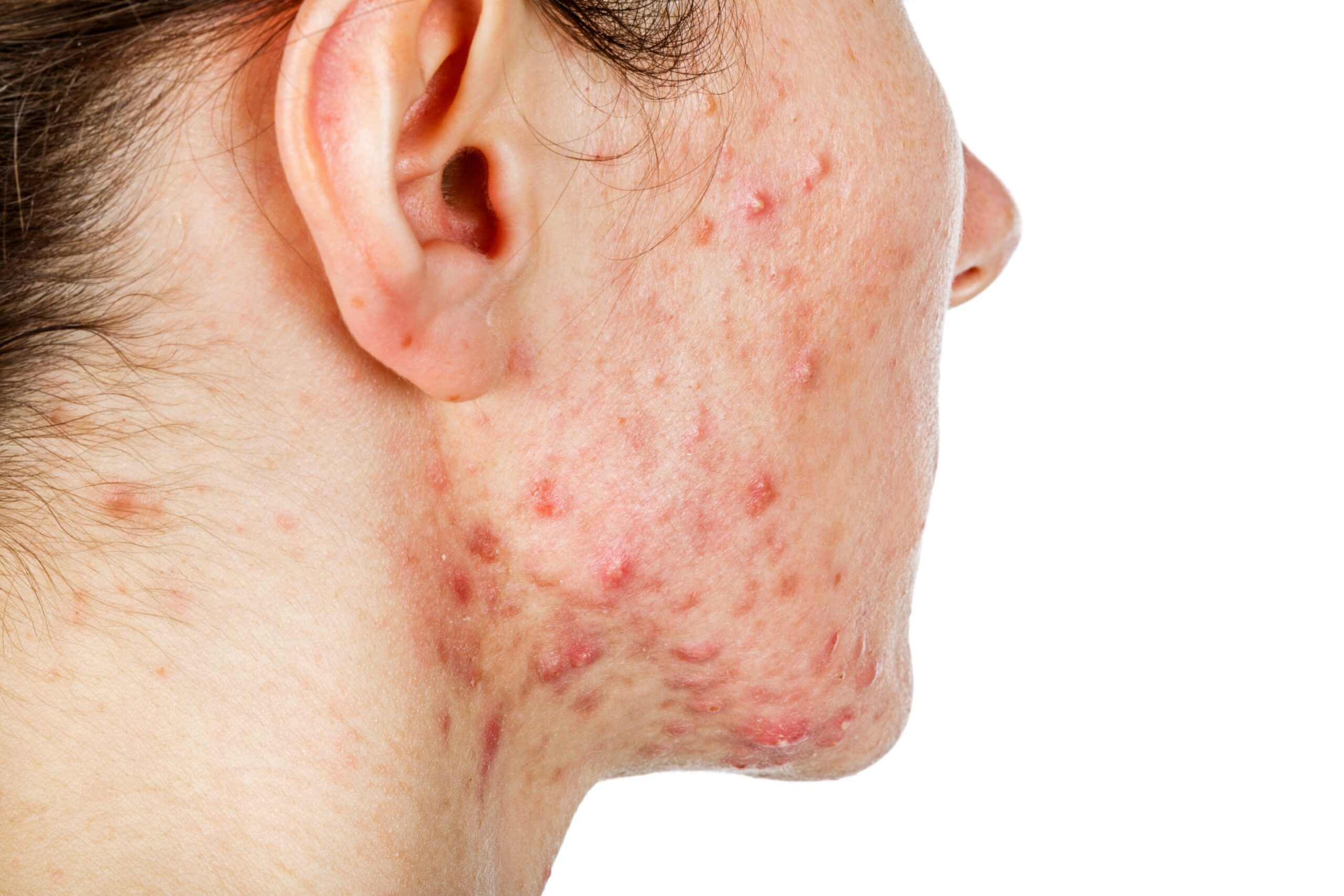 Acne na mulher adulta: por que ela aparece mesmo após os 30 anos