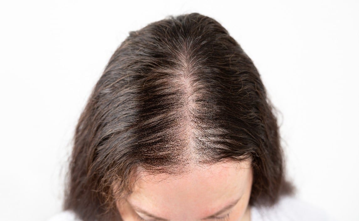 Queda de cabelo após Covid: por que ela acontece meses depois da infecção