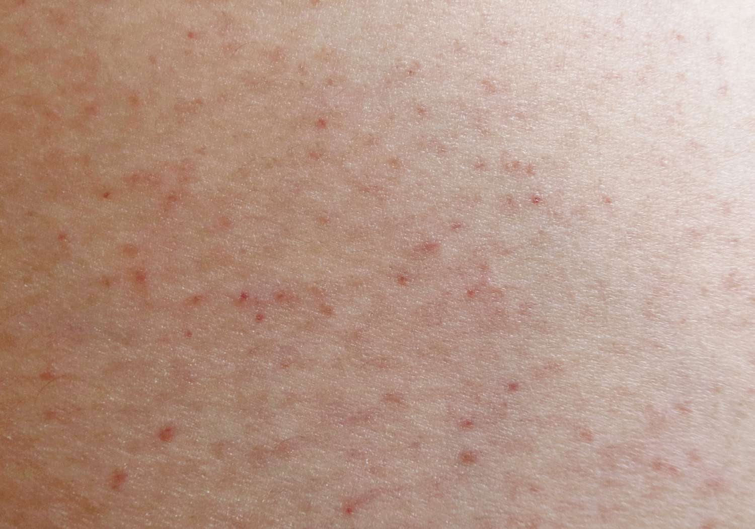 Foliculite nas nádegas: quando as “espinhas” não são acne