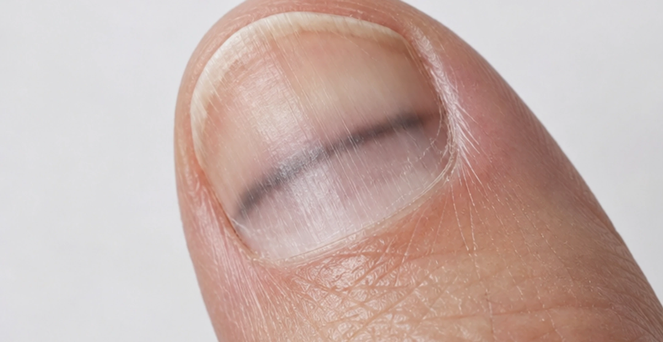 Linhas escuras nas unhas: quando a melanoniquia precisa ser investigada?
